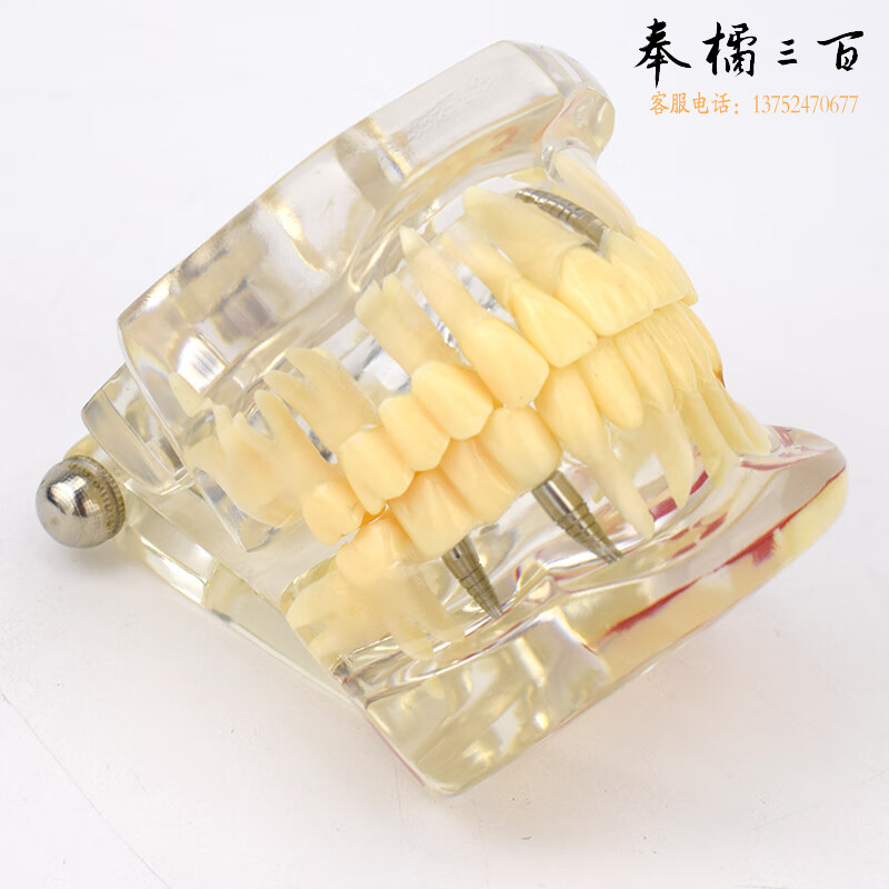 ENOVO颐诺口腔模型齿科修复种植阻生齿牙体牙髓口腔教学马里兰桥瓷贴面种植后连桥修复上后牙全瓷冠连桥
